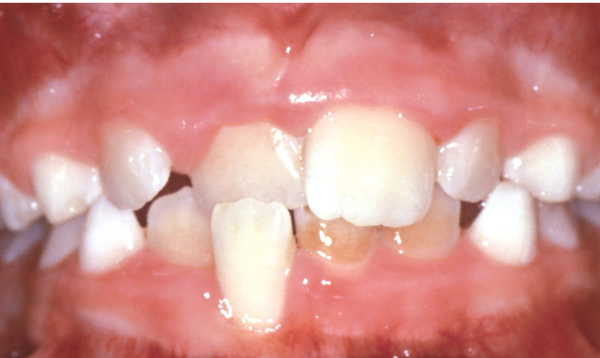 Crossbite of Front Teeth