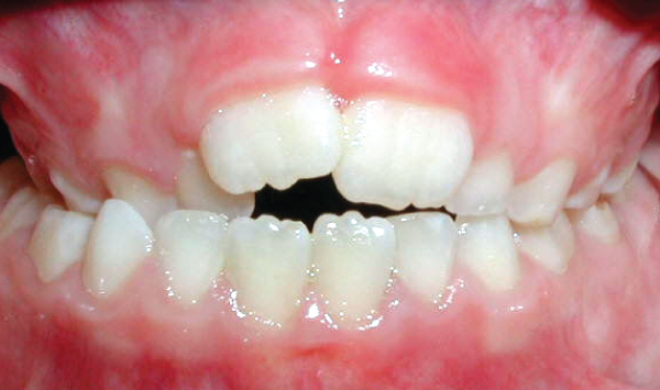 Crossbite of Back Teeth